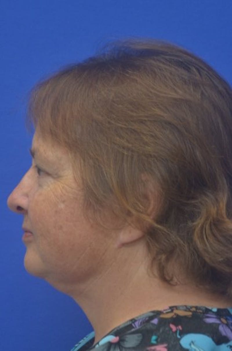Face Lift Before & After Gallery - Patient 373234 - Image 6
