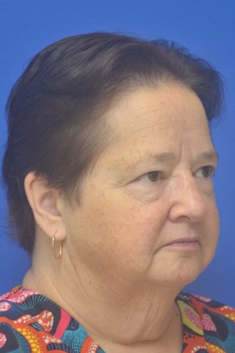 Face Lift Before & After Gallery - Patient 373234 - Image 7