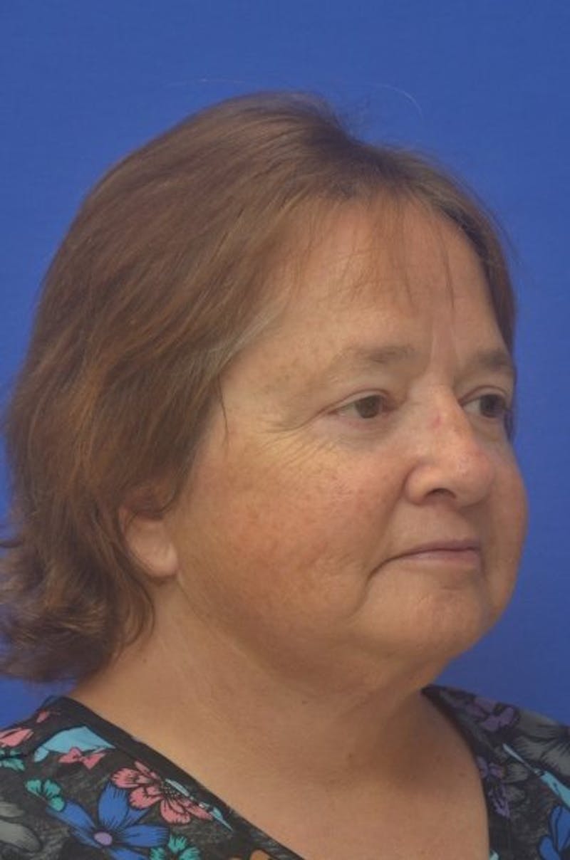 Face Lift Before & After Gallery - Patient 373234 - Image 8