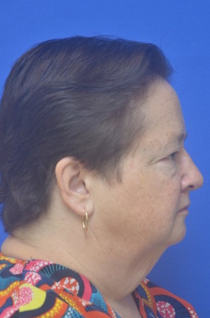 Face Lift Before & After Gallery - Patient 373234 - Image 9