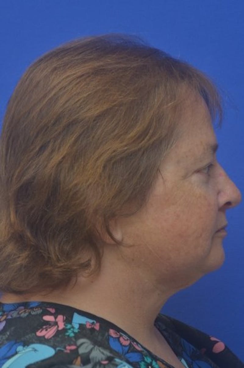 Face Lift Before & After Gallery - Patient 373234 - Image 10