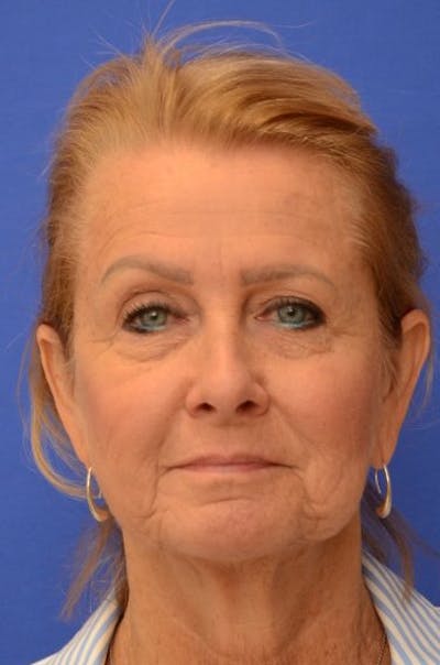 Facelift Before & After Gallery - Patient 392839 - Image 1