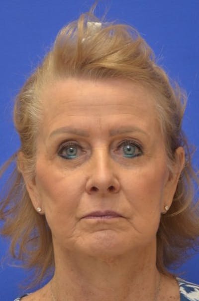 Facelift Before & After Gallery - Patient 392839 - Image 2