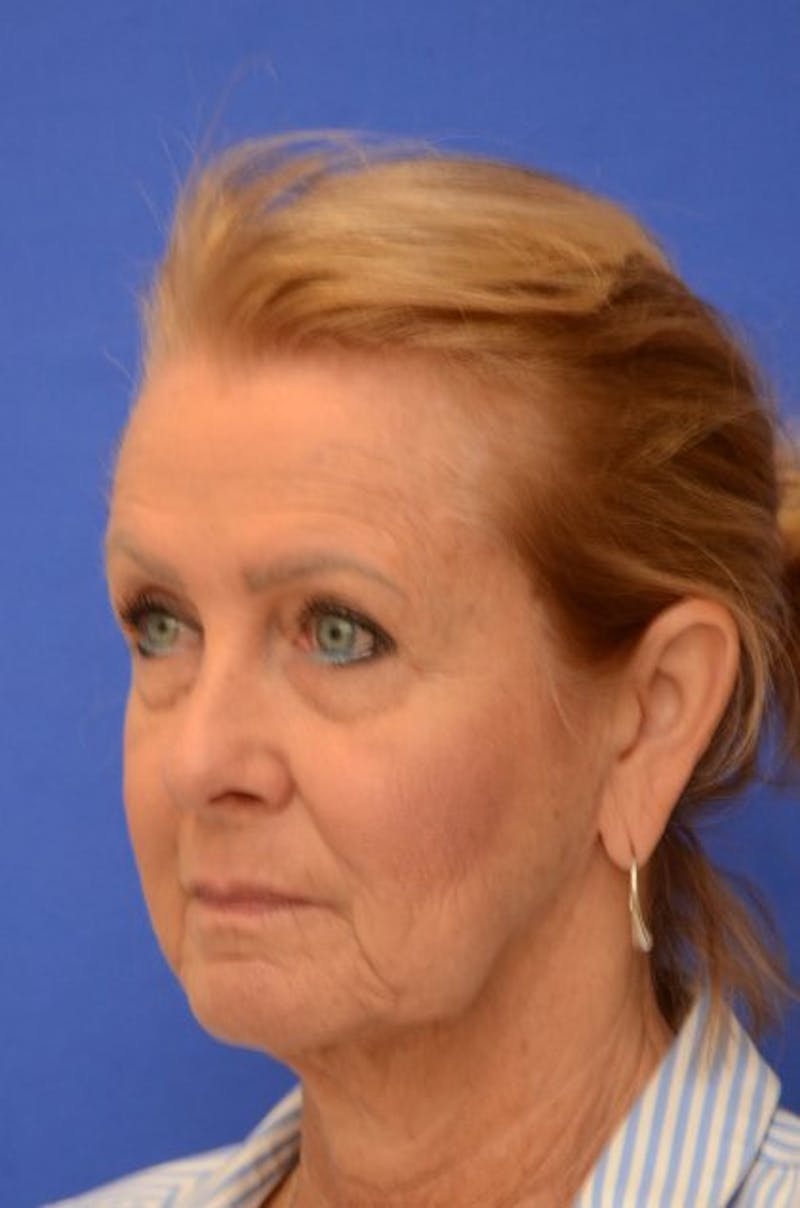 Face Lift Before & After Gallery - Patient 392839 - Image 3