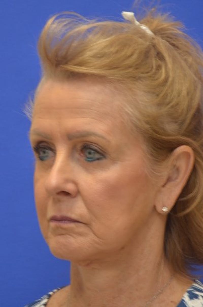 Face Lift Before & After Gallery - Patient 392839 - Image 4