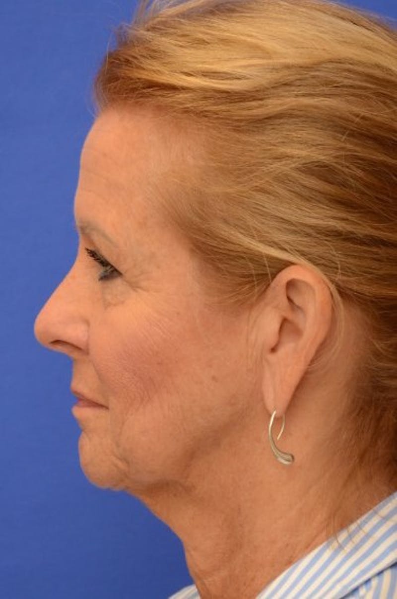 Face Lift Before & After Gallery - Patient 392839 - Image 5