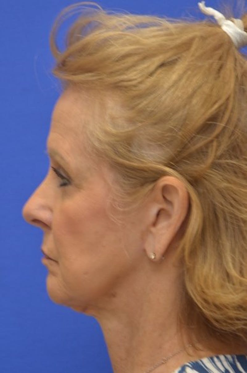Face Lift Before & After Gallery - Patient 392839 - Image 6