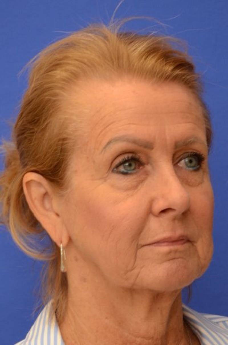 Face Lift Before & After Gallery - Patient 392839 - Image 7