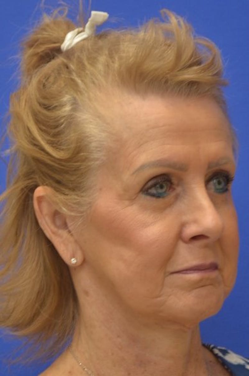 Face Lift Before & After Gallery - Patient 392839 - Image 8