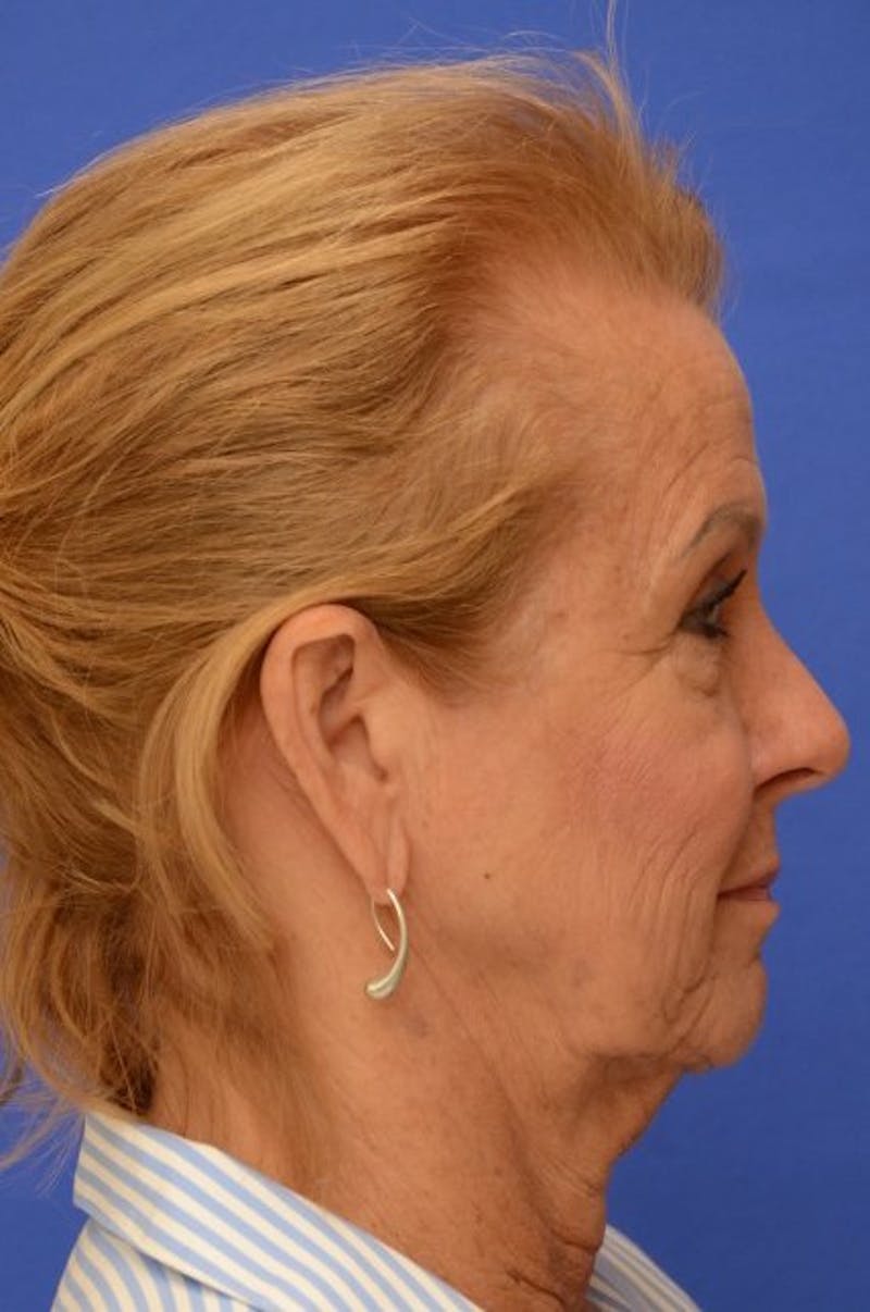 Face Lift Before & After Gallery - Patient 392839 - Image 9