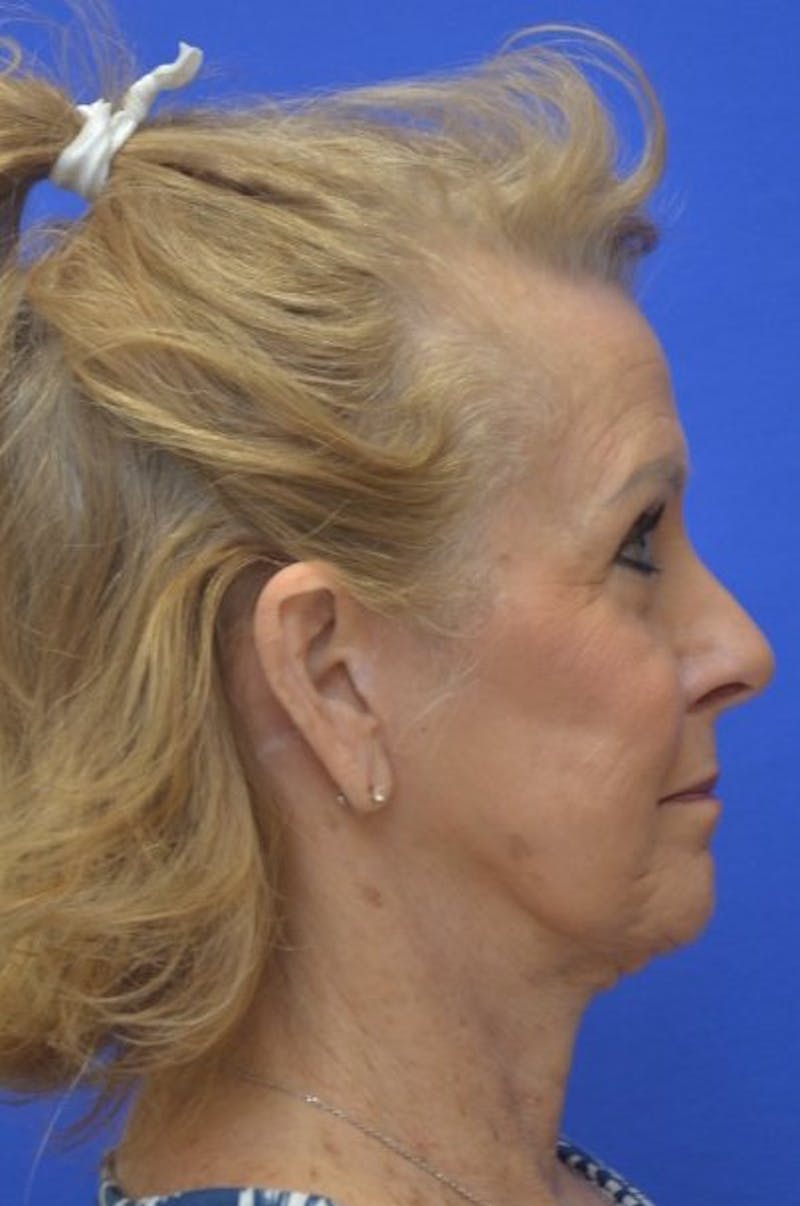 Face Lift Before & After Gallery - Patient 392839 - Image 10
