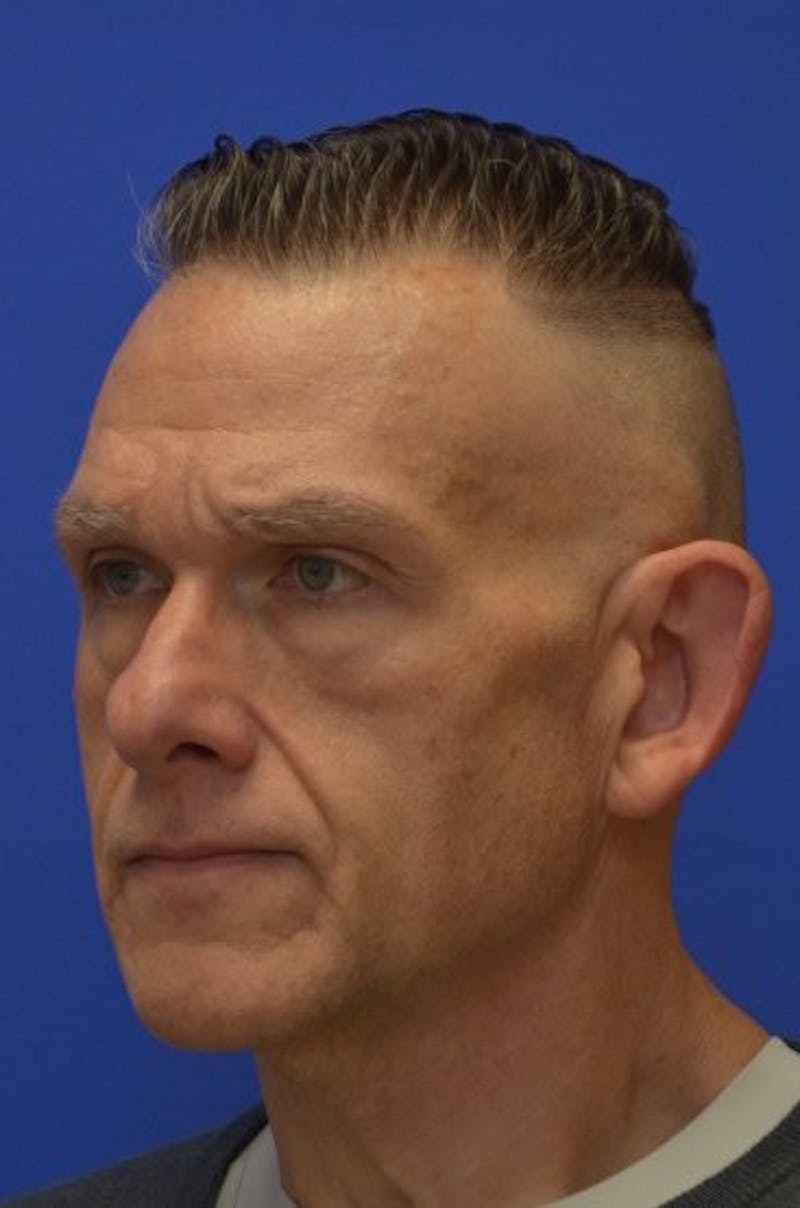 Face Lift Before & After Gallery - Patient 317385 - Image 3
