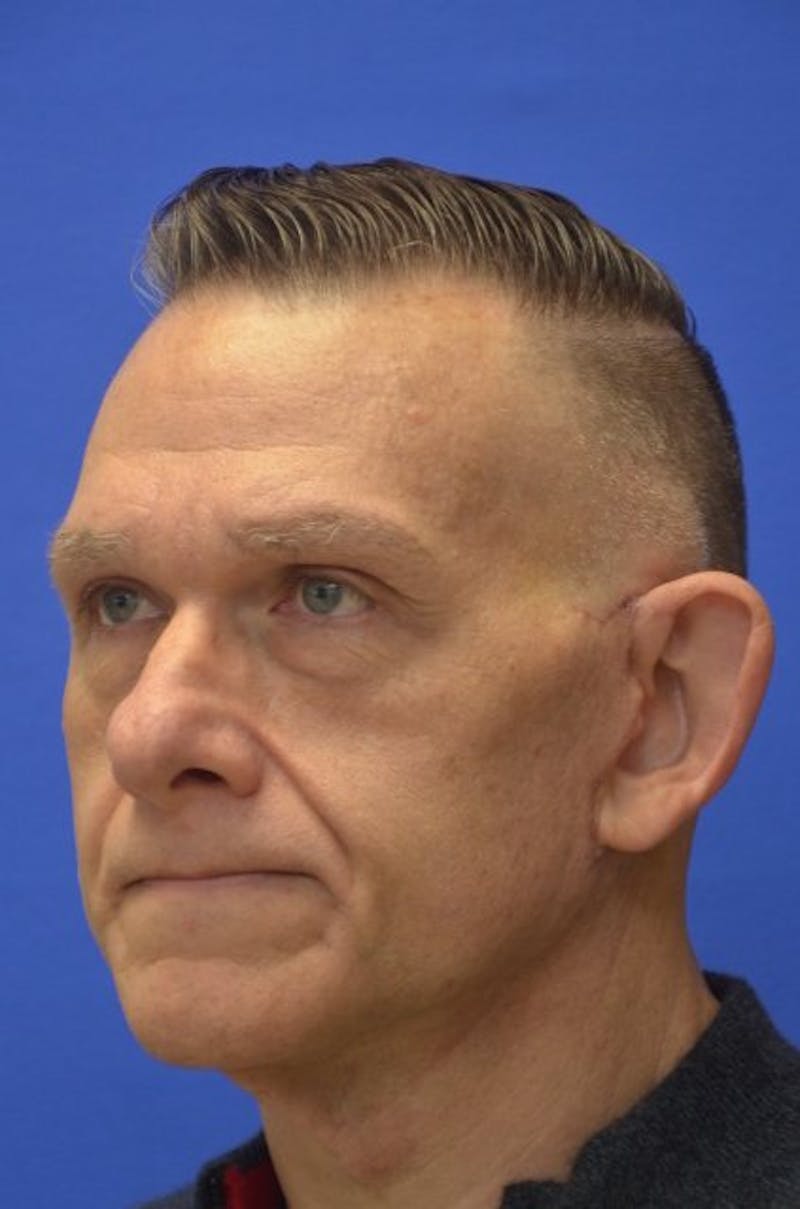 Face Lift Before & After Gallery - Patient 317385 - Image 4