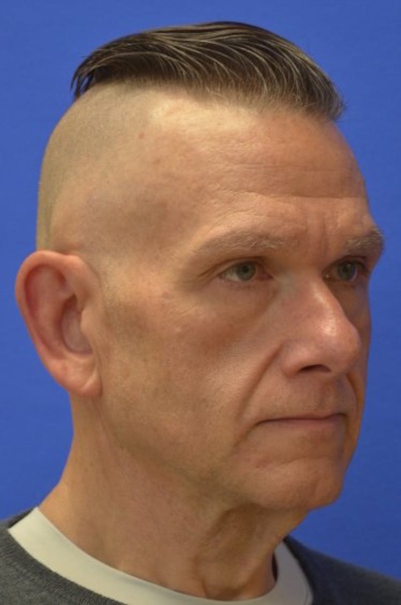 Face Lift Before & After Gallery - Patient 317385 - Image 5