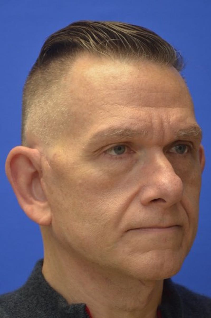 Face Lift Before & After Gallery - Patient 317385 - Image 6