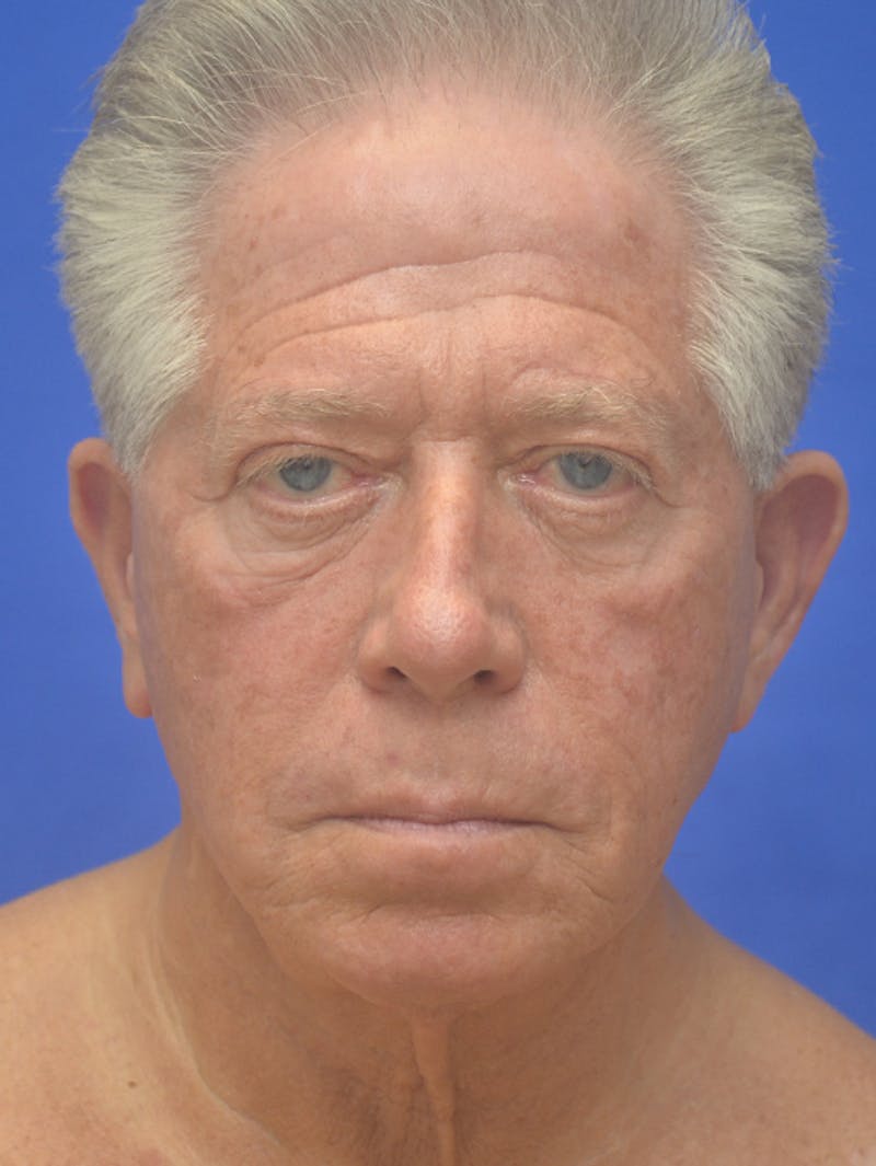 Face Lift Before & After Gallery - Patient 350046 - Image 1