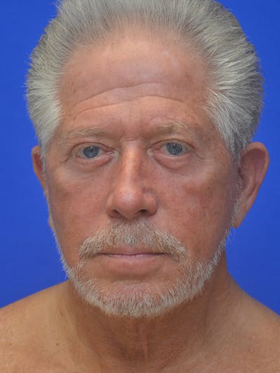 Face Lift Before & After Gallery - Patient 350046 - Image 2