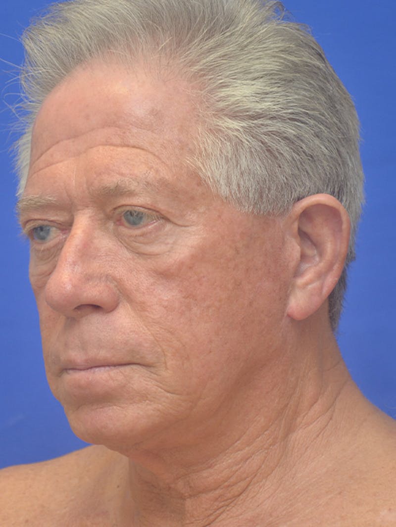 Face Lift Before & After Gallery - Patient 350046 - Image 3