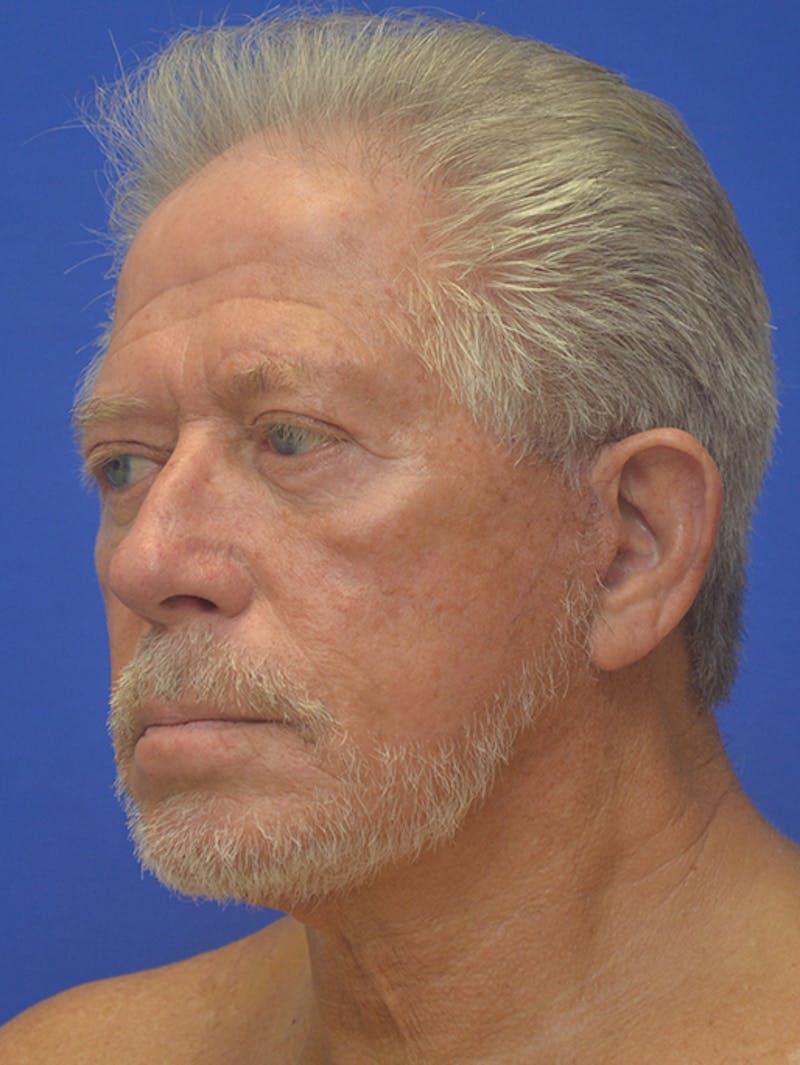Face Lift Before & After Gallery - Patient 350046 - Image 4
