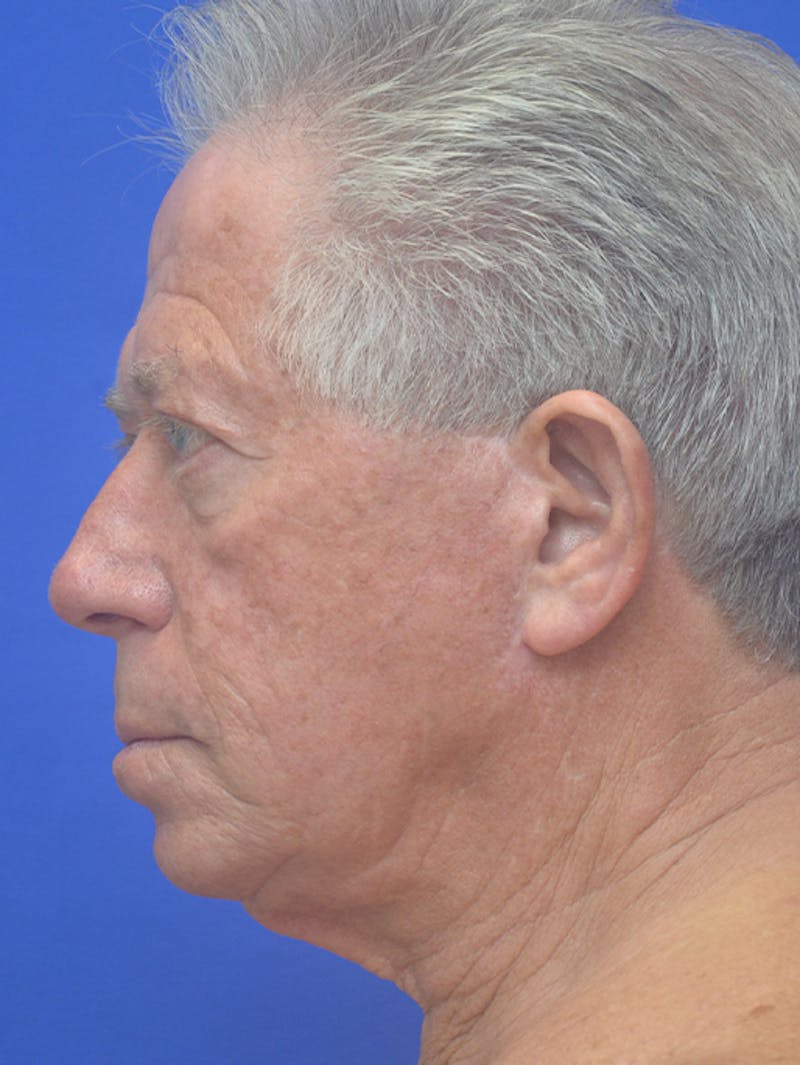Face Lift Before & After Gallery - Patient 350046 - Image 5