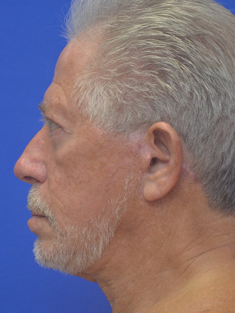 Face Lift Before & After Gallery - Patient 350046 - Image 6