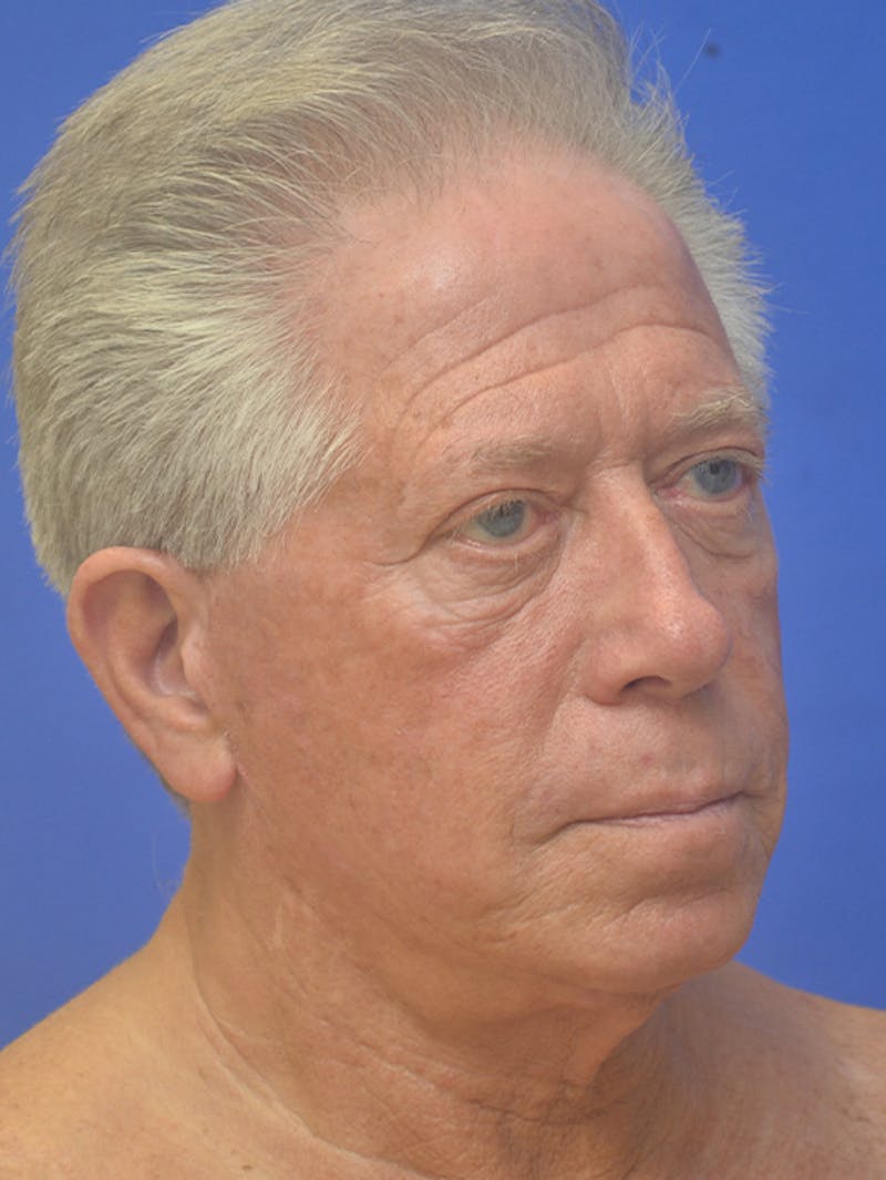 Face Lift Before & After Gallery - Patient 350046 - Image 7
