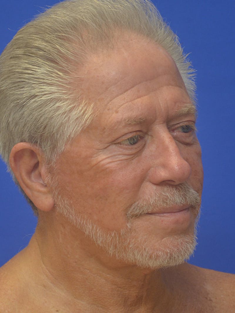 Face Lift Before & After Gallery - Patient 350046 - Image 8