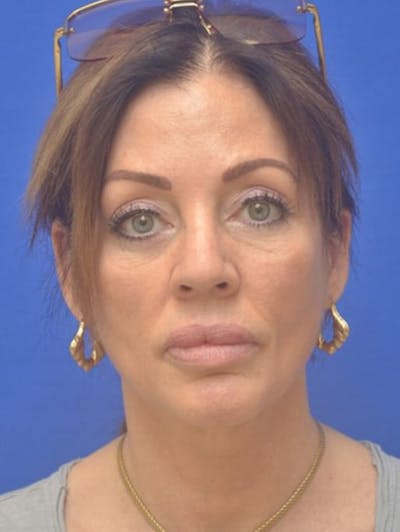 Face Lift Before & After Gallery - Patient 243416 - Image 1