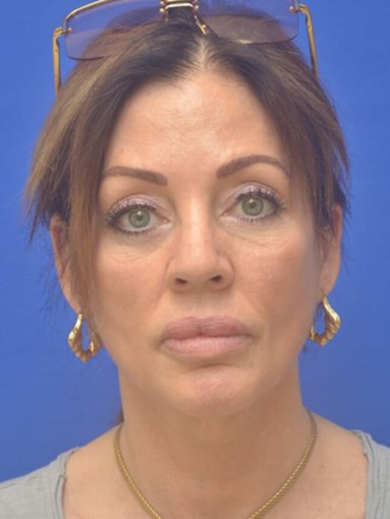 Face Lift Before & After Gallery - Patient 243416 - Image 1
