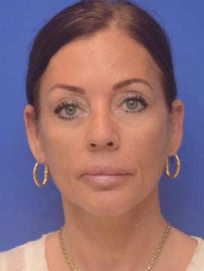 Face Lift Before & After Gallery - Patient 243416 - Image 2