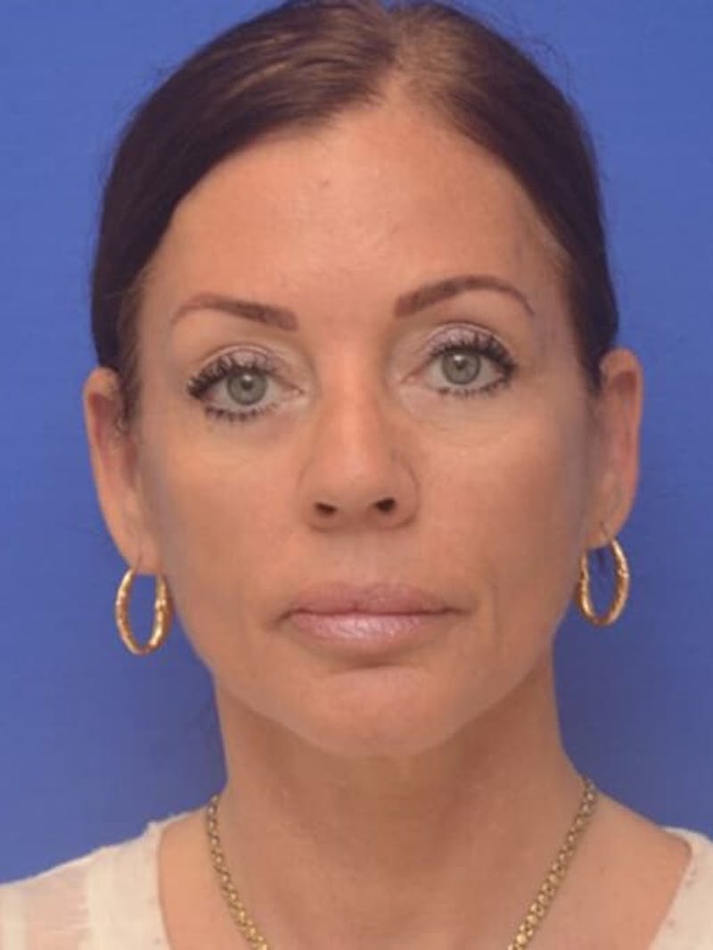 Face Lift Before & After Gallery - Patient 243416 - Image 2