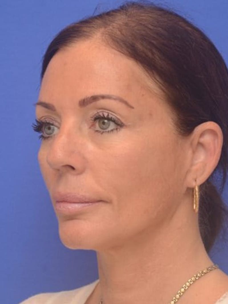 Face Lift Before & After Gallery - Patient 243416 - Image 4