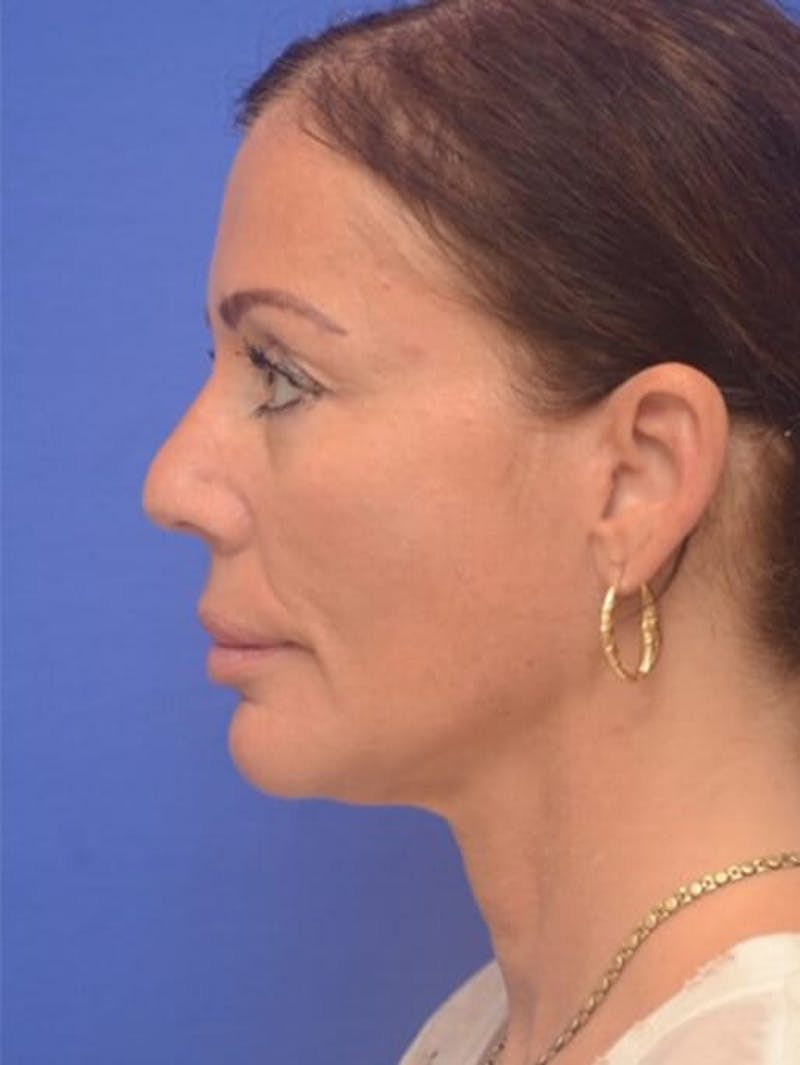 Face Lift Before & After Gallery - Patient 243416 - Image 6