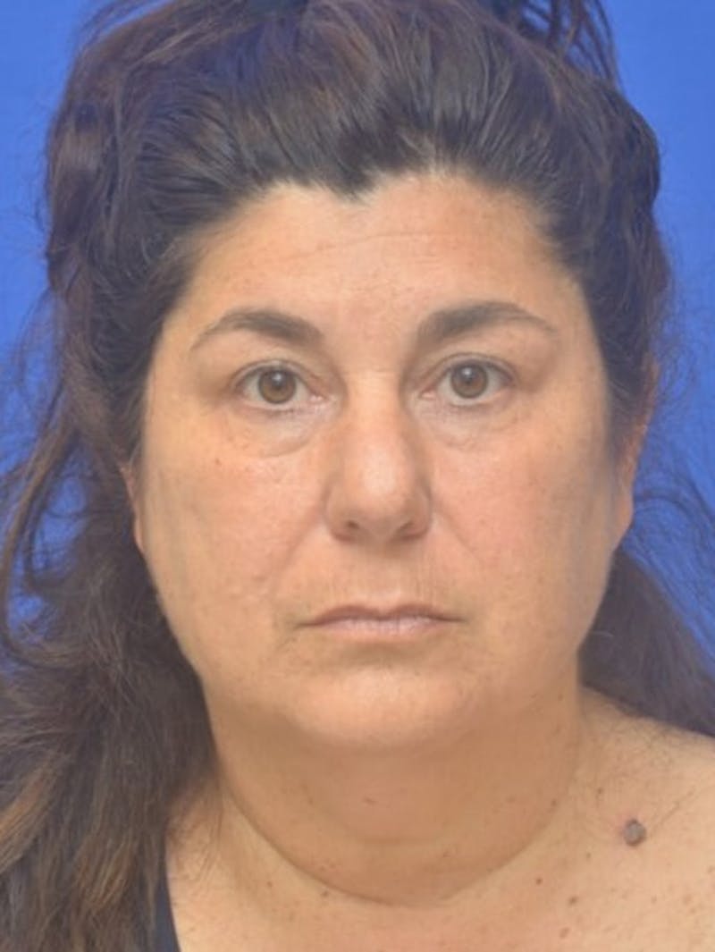 Face Lift Before & After Gallery - Patient 138705 - Image 1