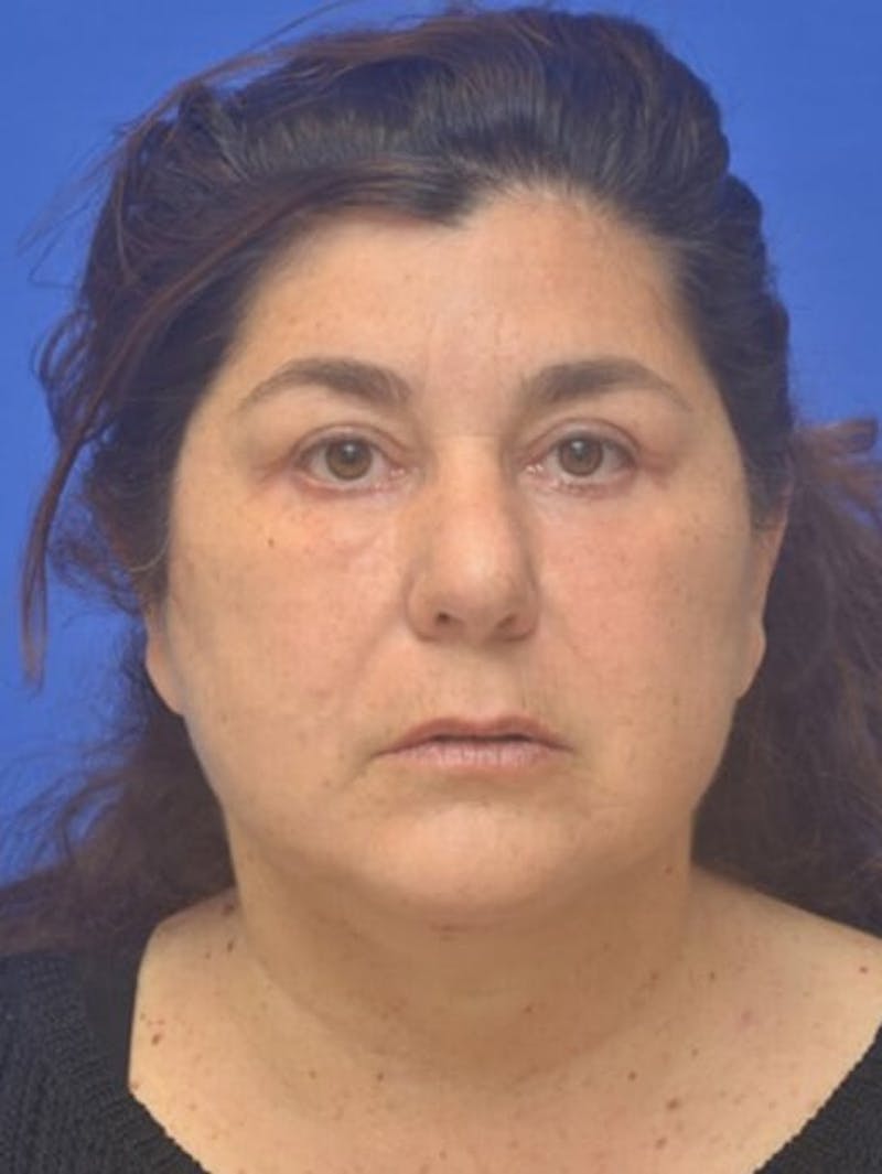 Face Lift Before & After Gallery - Patient 138705 - Image 2