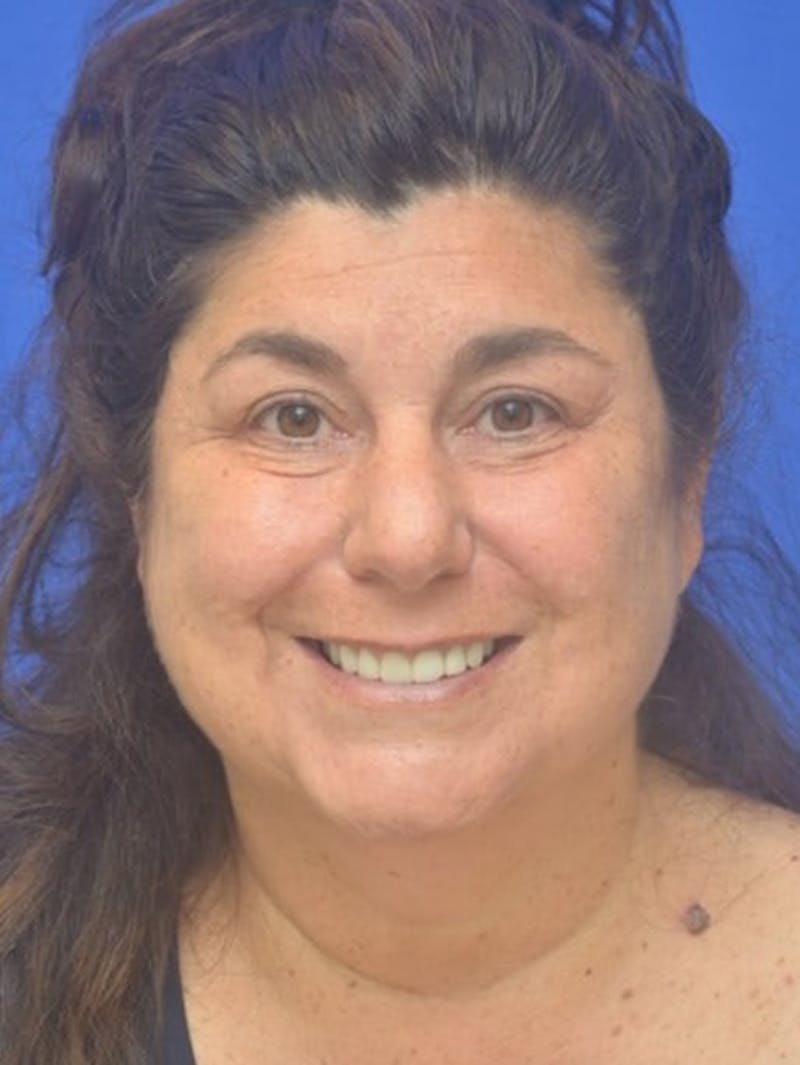 Face Lift Before & After Gallery - Patient 138705 - Image 3