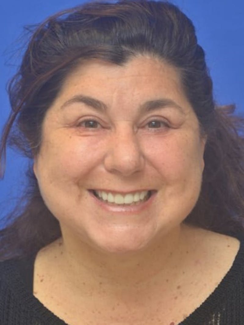 Face Lift Before & After Gallery - Patient 138705 - Image 4