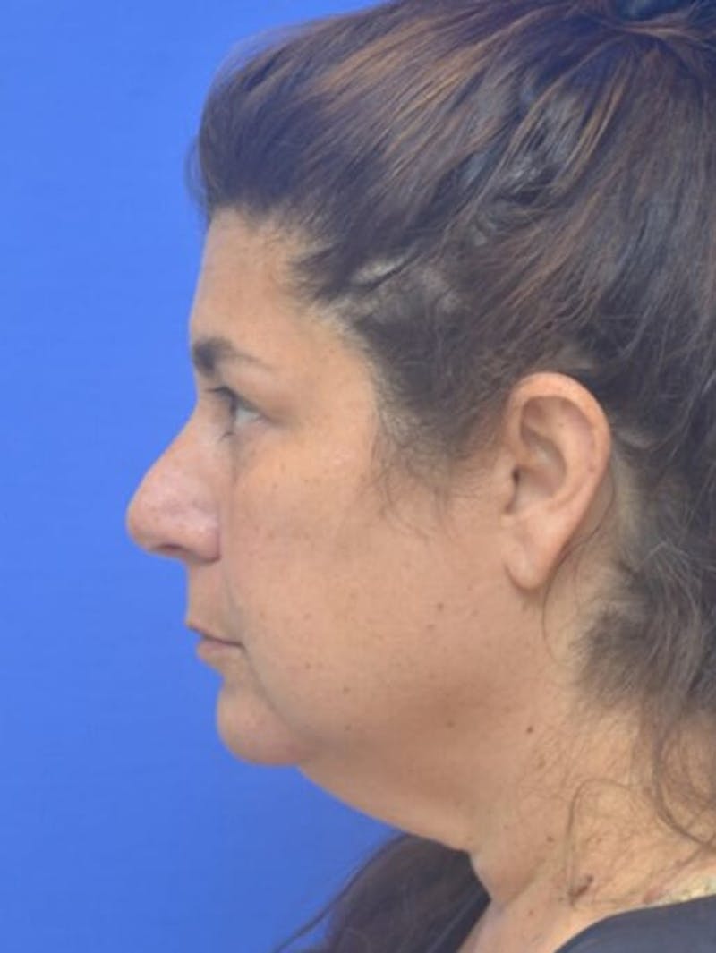 Face Lift Before & After Gallery - Patient 138705 - Image 5