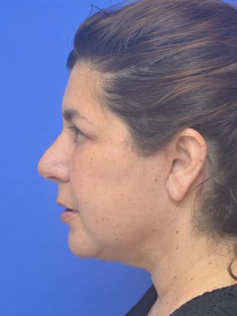Face Lift Before & After Gallery - Patient 138705 - Image 6