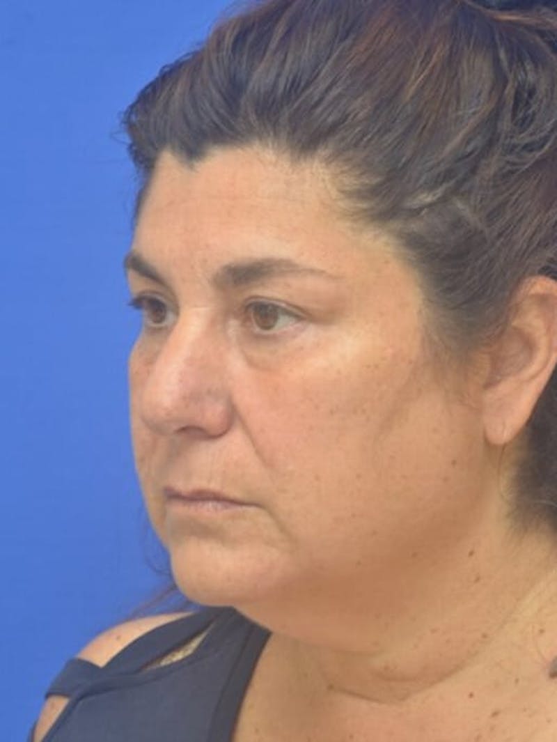 Face Lift Before & After Gallery - Patient 138705 - Image 7
