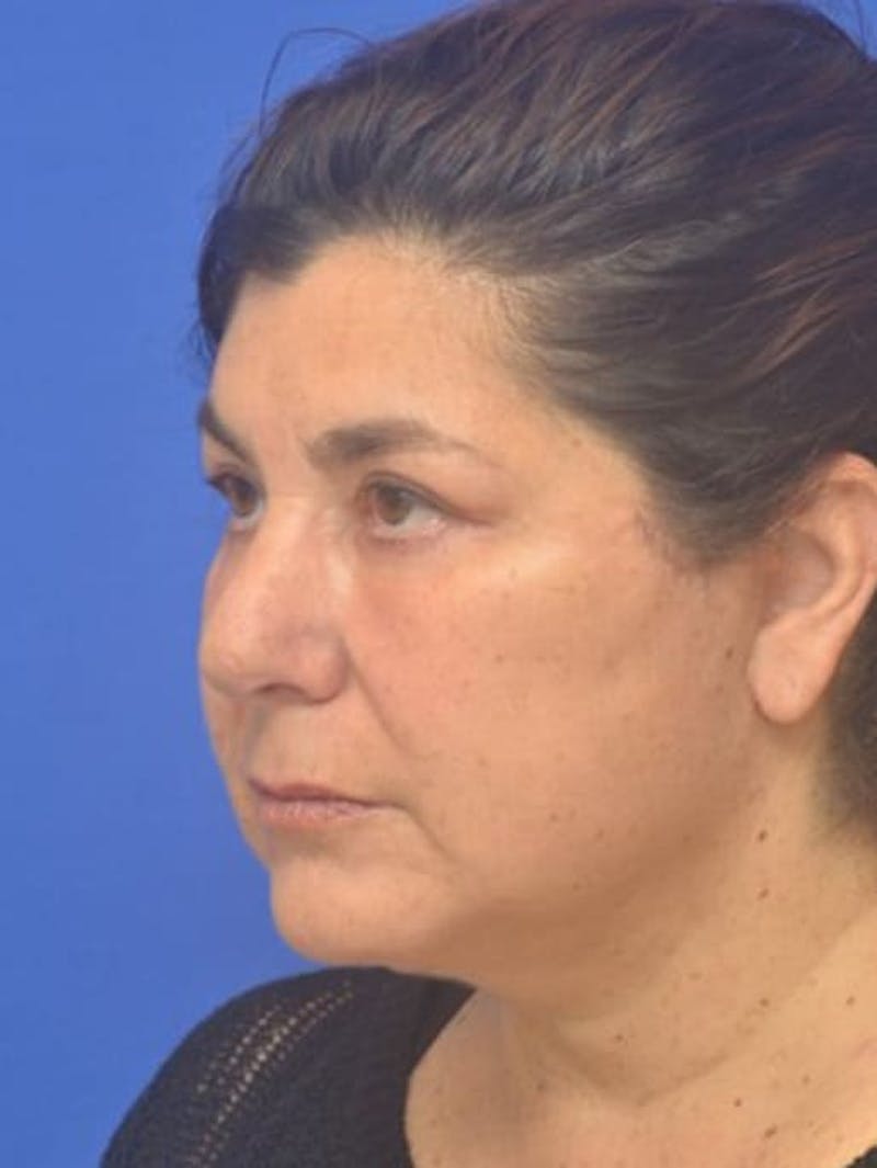 Face Lift Before & After Gallery - Patient 138705 - Image 8