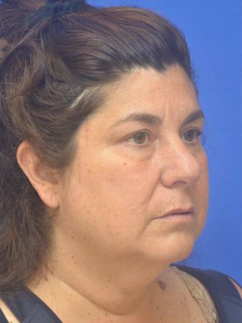 Face Lift Before & After Gallery - Patient 138705 - Image 9