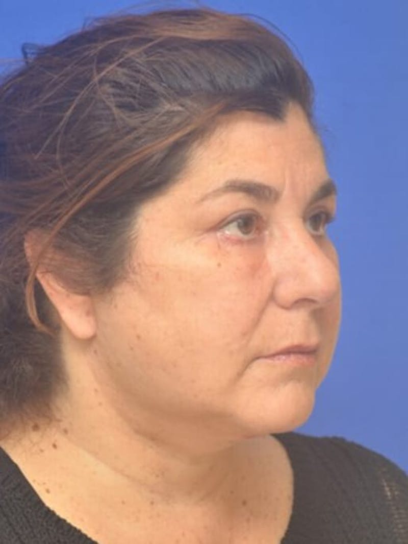 Face Lift Before & After Gallery - Patient 138705 - Image 10