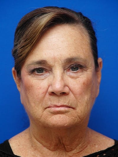 Face Lift Before & After Gallery - Patient 223359 - Image 1