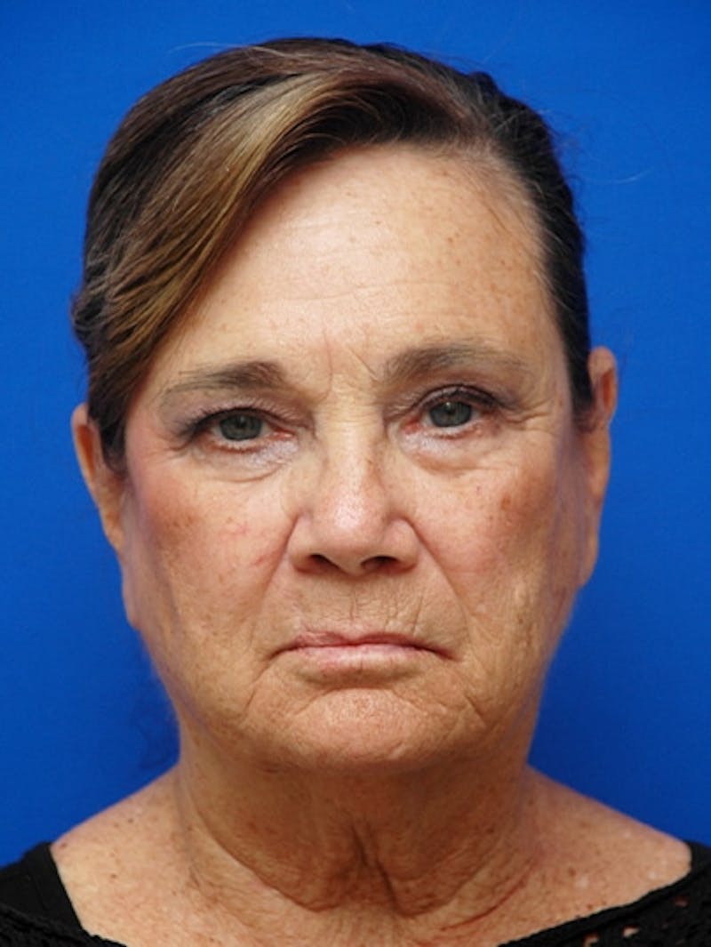 Face Lift Before & After Gallery - Patient 223359 - Image 1