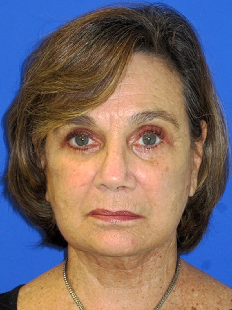 Face Lift Before & After Gallery - Patient 223359 - Image 2