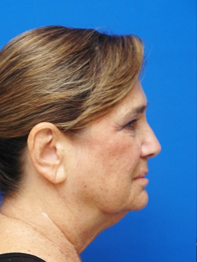 Face Lift Before & After Gallery - Patient 223359 - Image 3