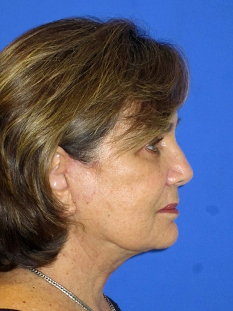 Face Lift Before & After Gallery - Patient 223359 - Image 4