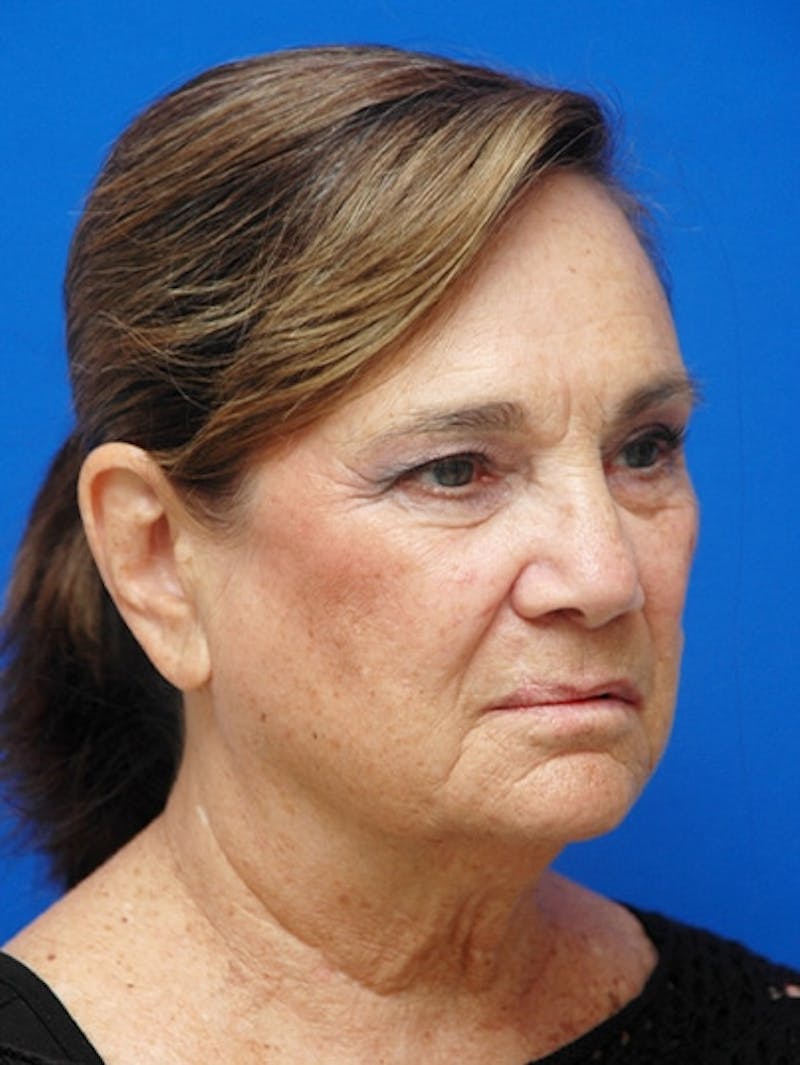 Face Lift Before & After Gallery - Patient 223359 - Image 5