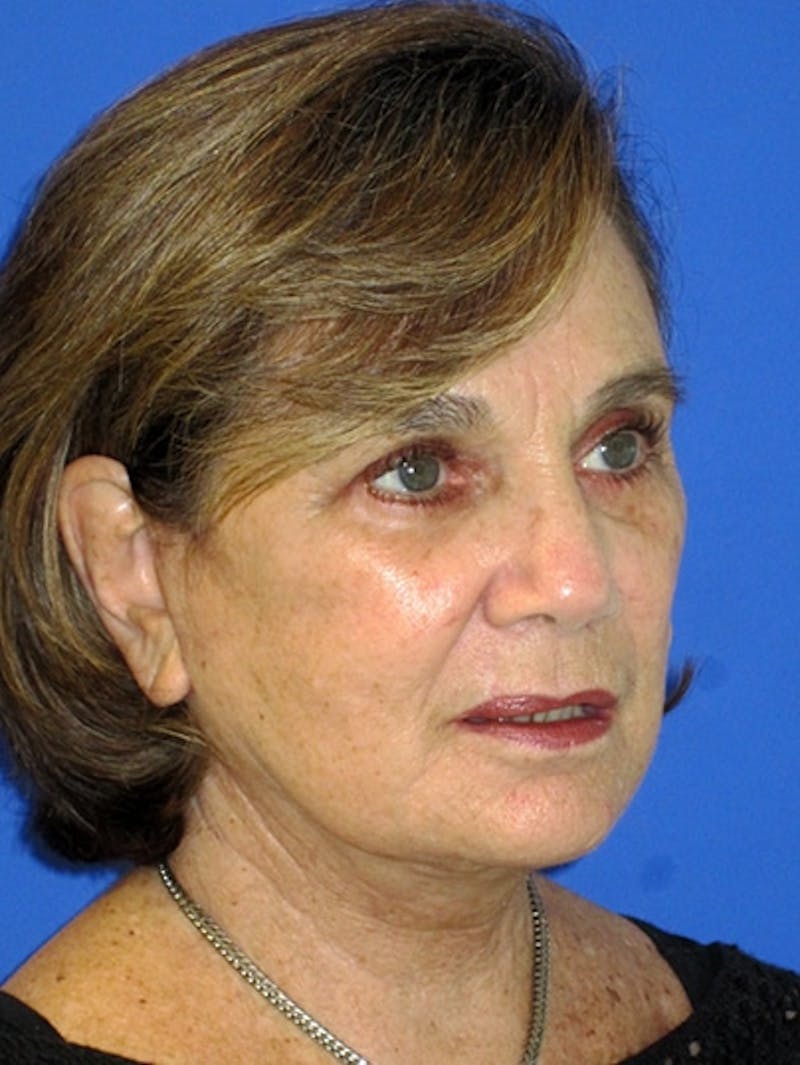 Face Lift Before & After Gallery - Patient 223359 - Image 6